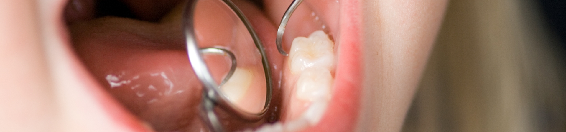子どもの虫歯治療(小児歯科)-こども歯科