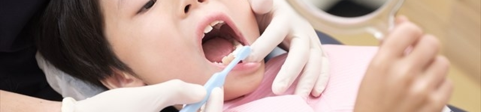 小児矯正治療-こども歯科