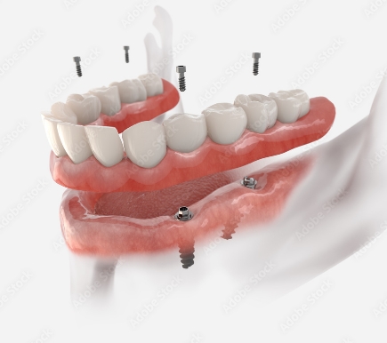 インプラント義歯も可能