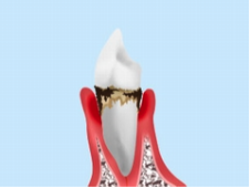 中期歯周炎