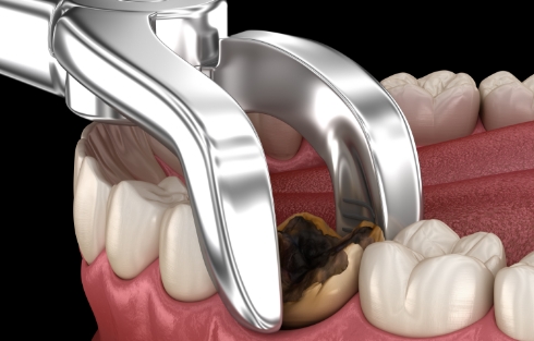 抜歯窩（抜歯直後）への歯の移植